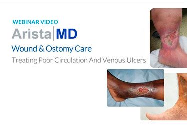 Wound Care eConsults: Treating Poor Circulation and Venous Ulcers